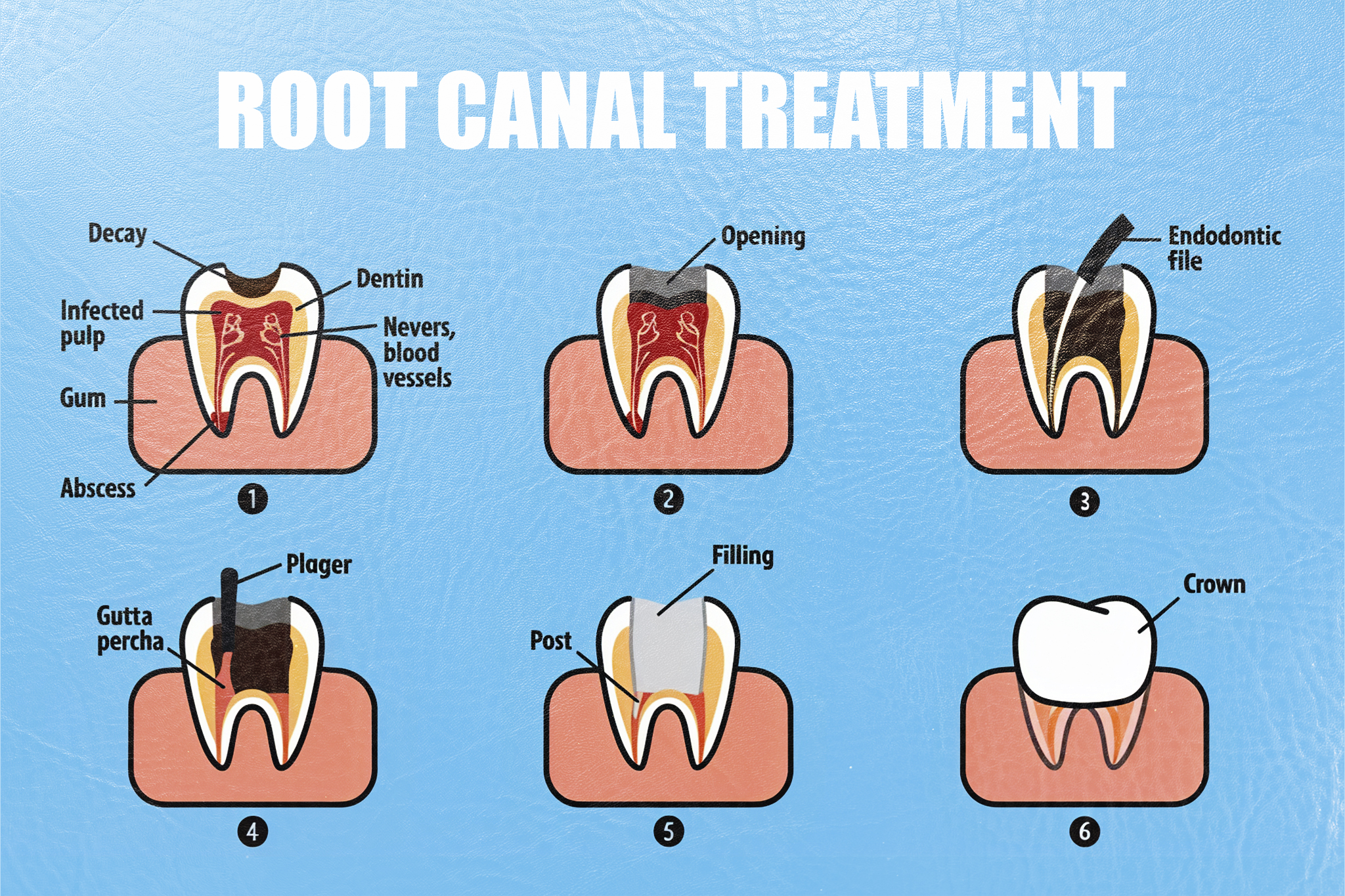 Signs You Need a Root Canal Treatment and How Sobti Nursing Home Can Help