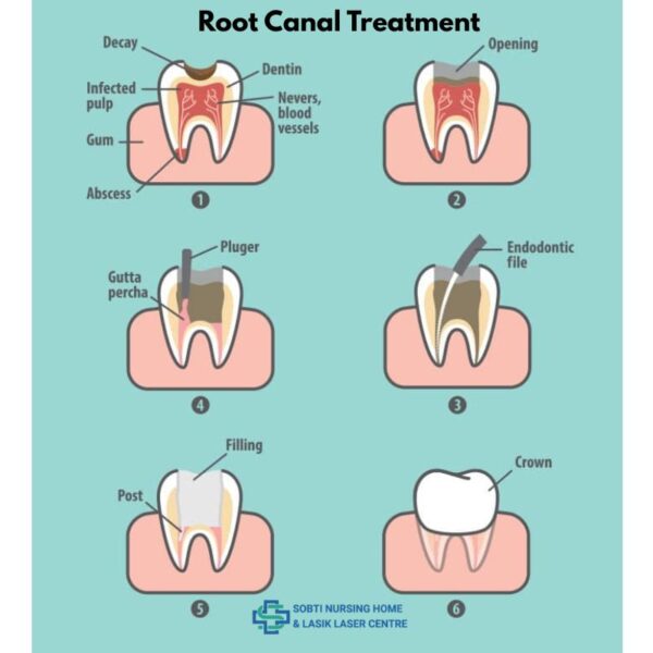 Signs You Need a Root Canal Treatment and How Sobti Nursing Home Can Help