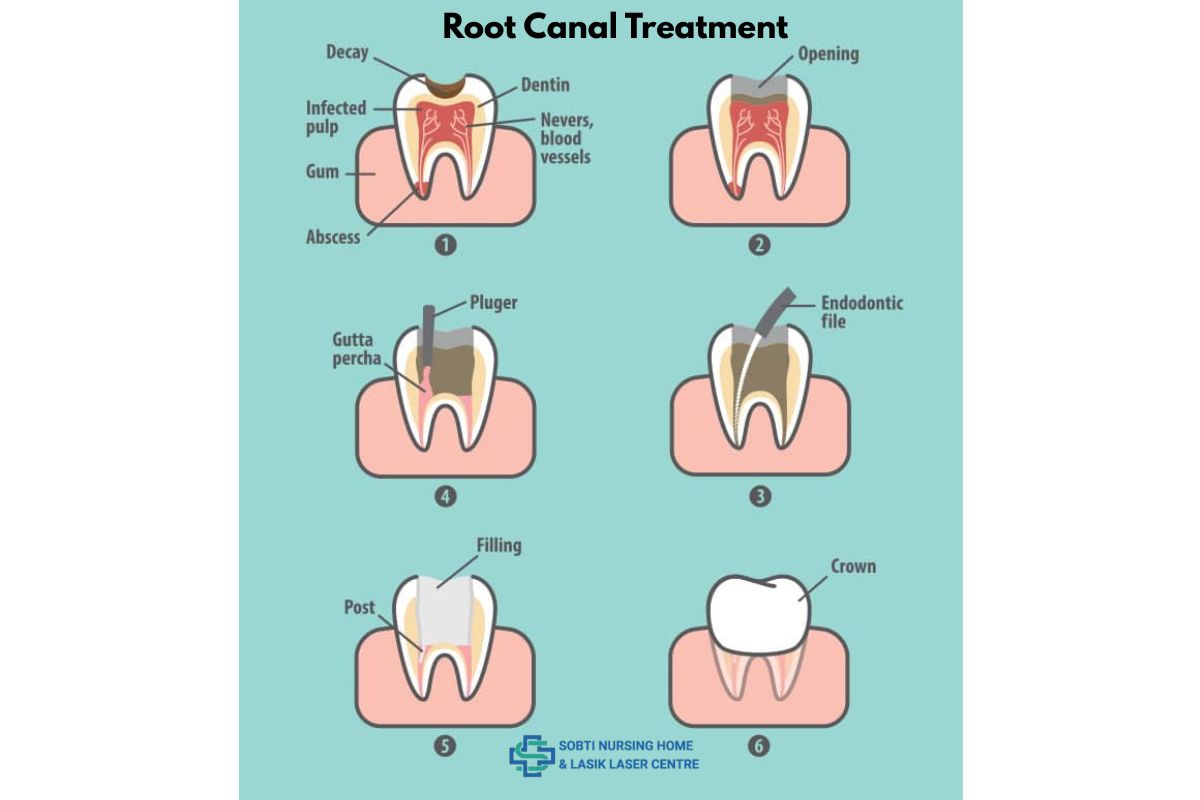 Signs You Need a Root Canal Treatment and How Sobti Nursing Home Can Help